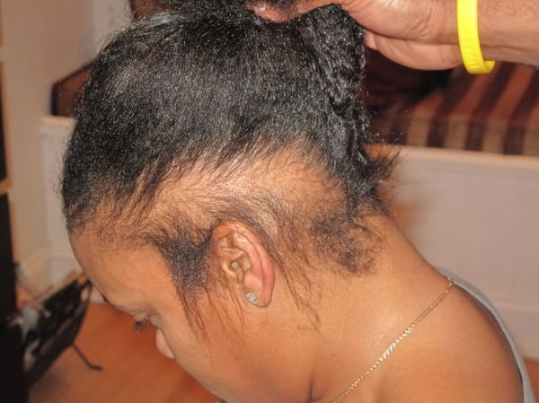 HAIR LOSS (ALOPECIA)- CAUSES, PREVENTION AND TREATMENT