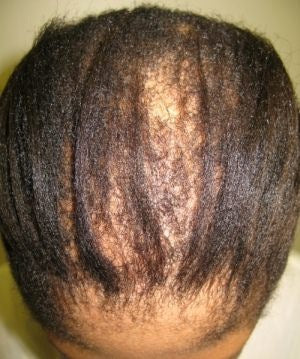 REASON FOR EARLY HAIR LOSS - BALDNESS